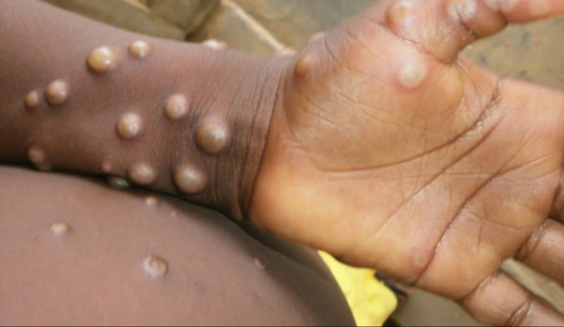 NCDC Reports 66 Confirmed Monkeypox Cases And One Death