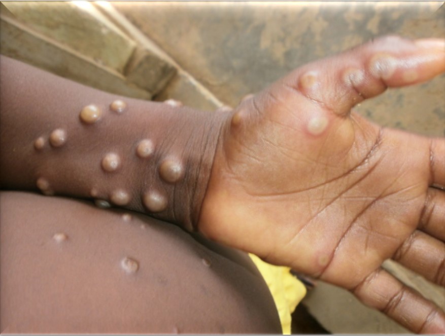NCDC Confirms 157 Monkeypox Cases And 4 Deaths In 26 States